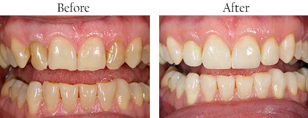 El Cajon Before and After Dental Implants