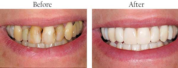 Santee Before and After Teeth Whitening